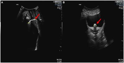 Migration of an intrauterine device to the posterior urethra with stone formation: a case report